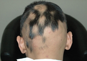 علت و درمان ریزش مو سکه ای یا بیماری آلوپسی آره آتا چیست؟